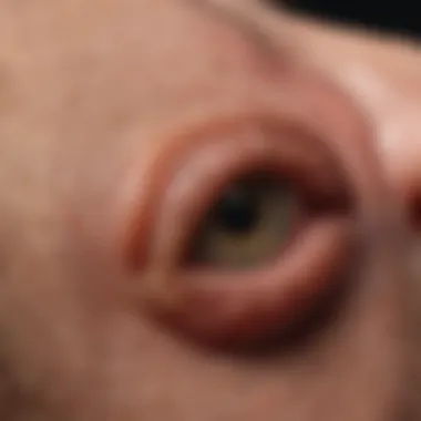 Identifying Chigger Bite Reactions Skin showing symptoms of chigger bites